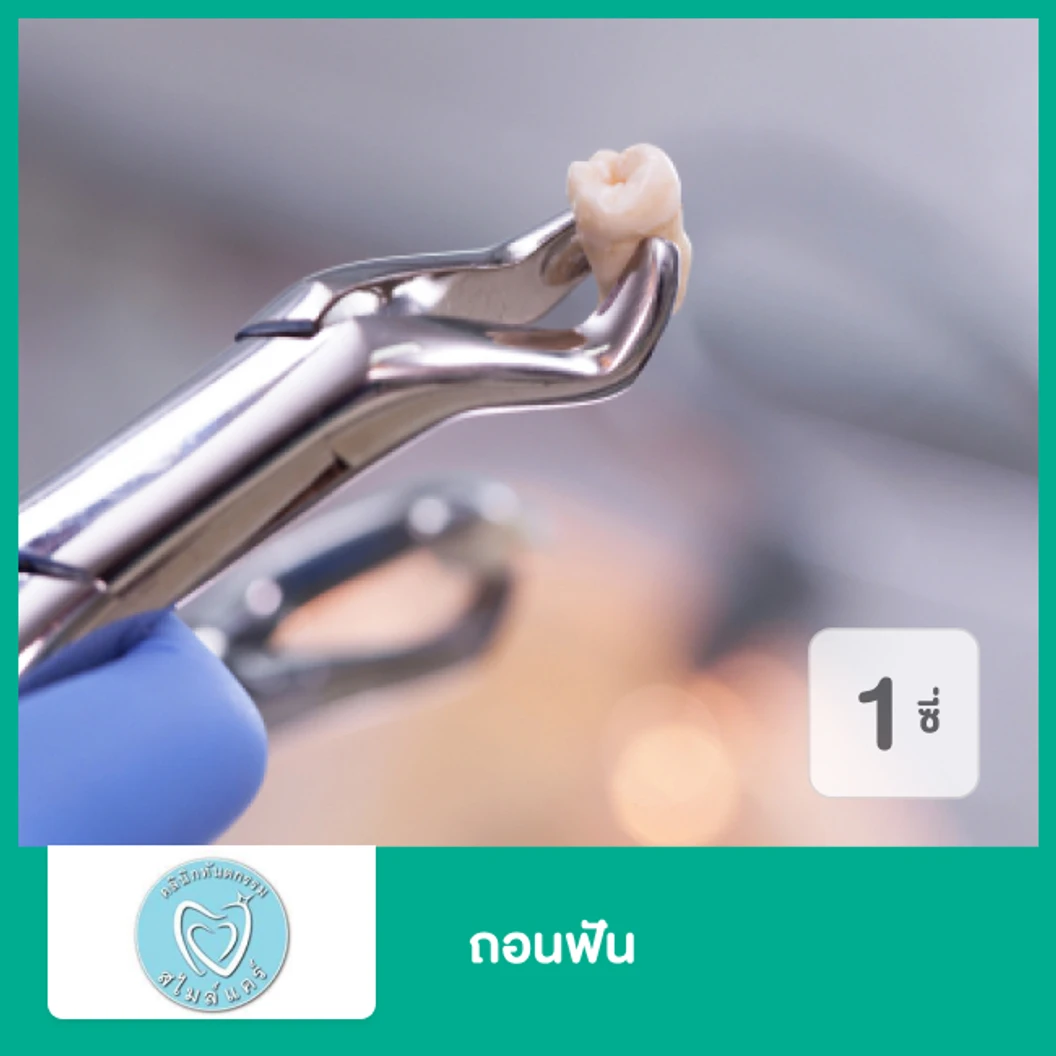 ถอนฟัน 1 ซี่