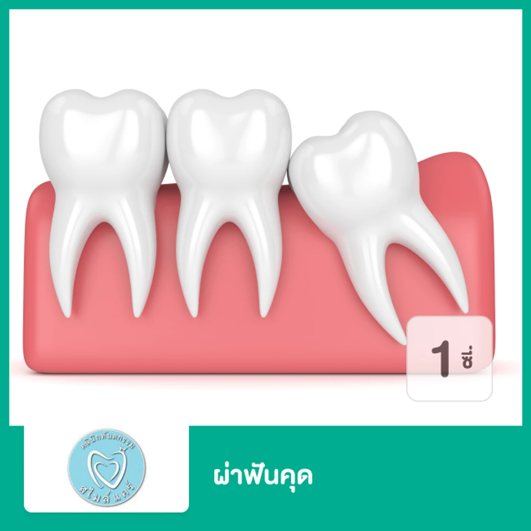 ถอนหรือผ่าฟันคุด 1 ซี่