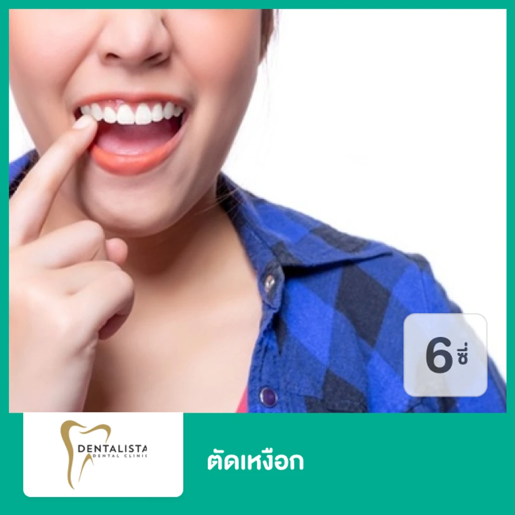 ตัดเหงือก สำหรับฟัน 6 ซี่