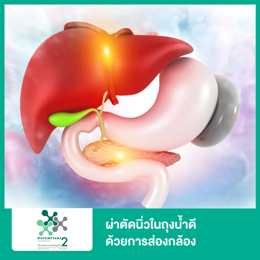 ผ่าตัดนิ่วในถุงน้ำดีด้วยการส่องกล้อง (Laparoscopic Cholecystectomy) ที่ โรงพยาบาลพญาไท 2