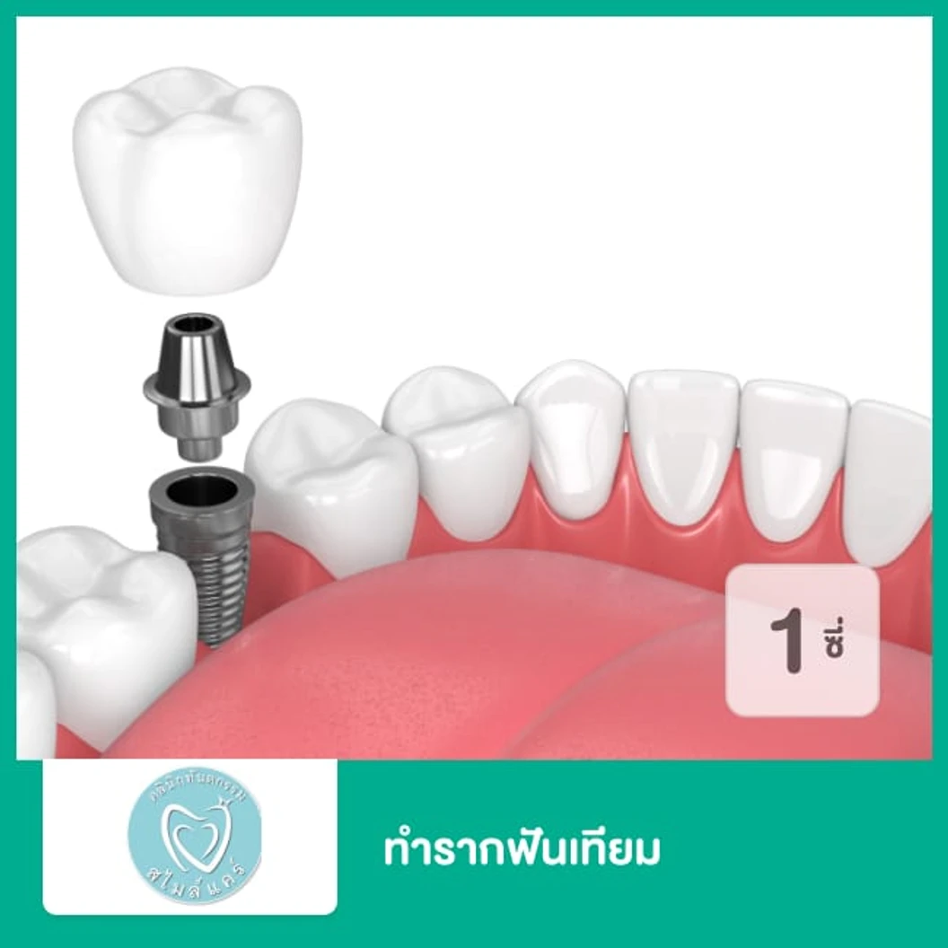 ทำรากฟันเทียม ยี่ห้อ Osstem สำหรับฟัน 1 ซี่