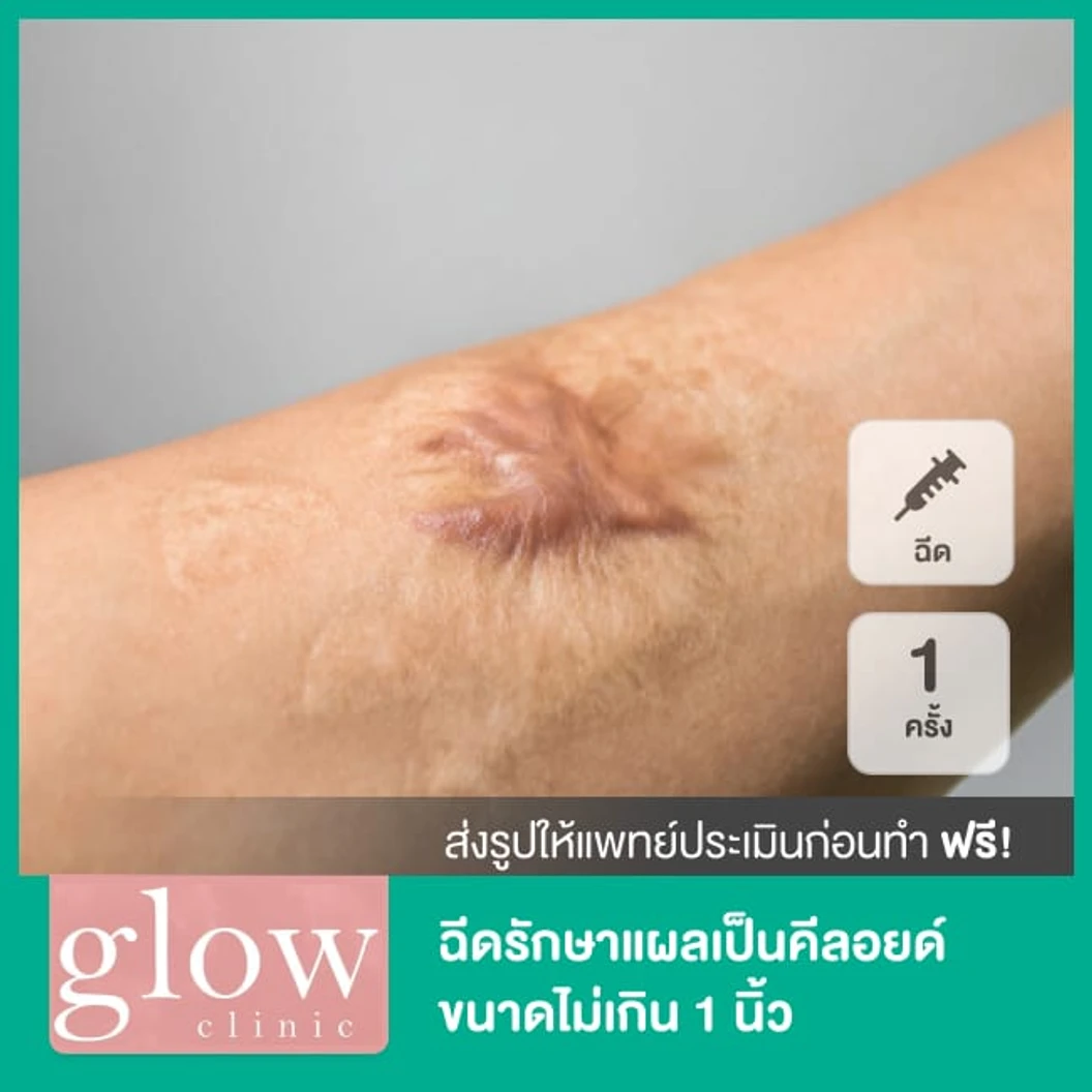 ฉีดรักษาแผลเป็นคีลอยด์ขนาดไม่เกิน 1 นิ้ว 1 ครั้ง