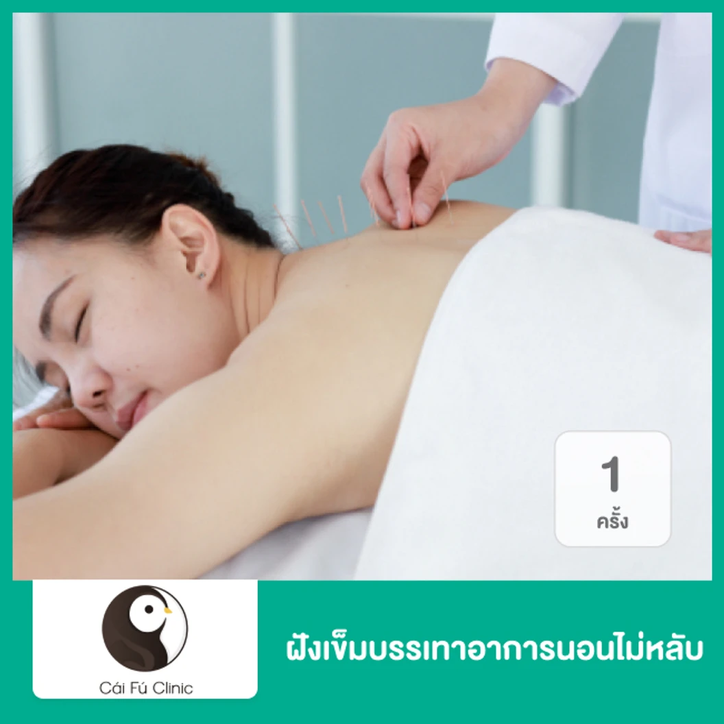 ฝังเข็มบรรเทาอาการนอนไม่หลับ 1 ครั้ง