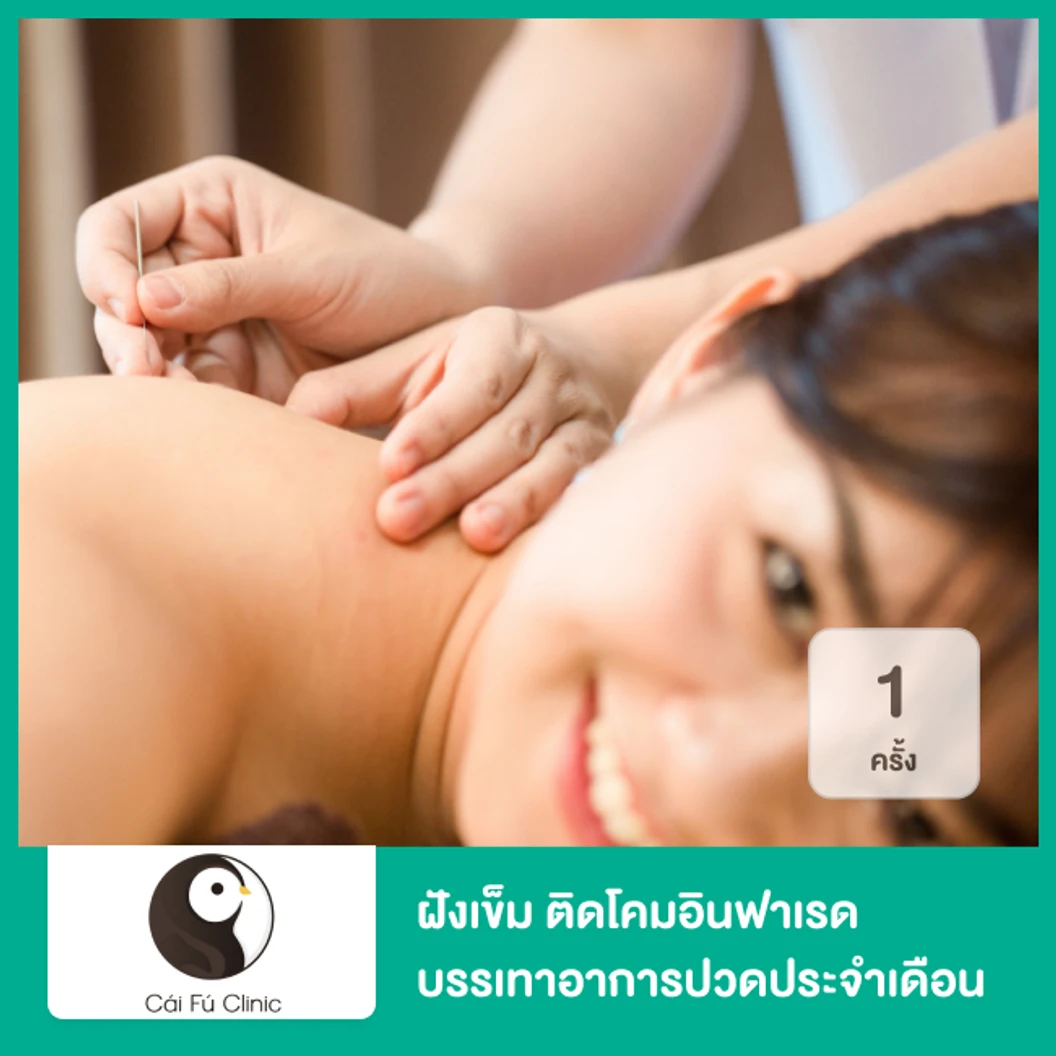 ฝังเข็ม ติดโคมอินฟาเรด บรรเทาอาการปวดประจำเดือน ประจำเดือนมาไม่ปกติ 1 ครั้ง