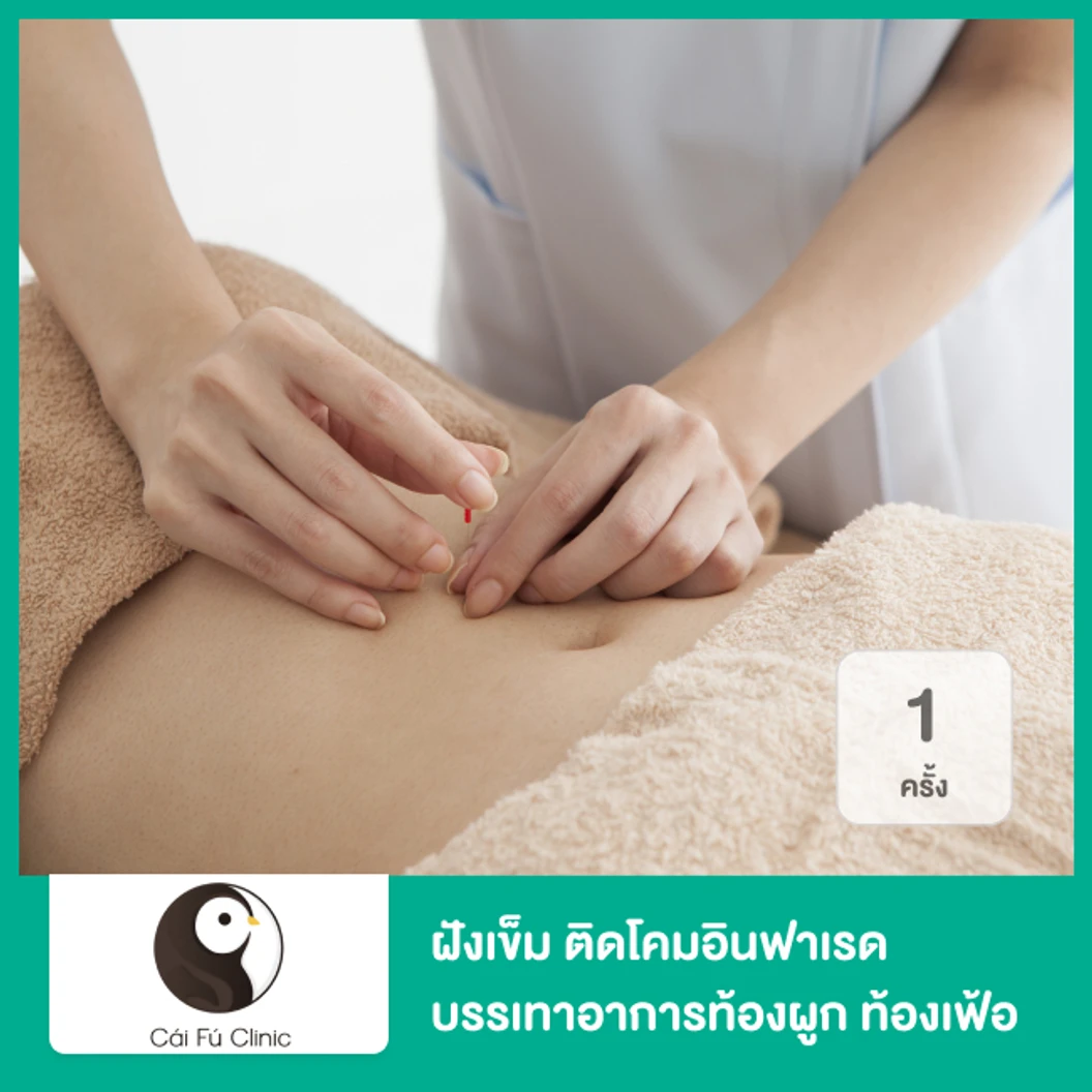 ฝังเข็ม ติดโคมอินฟาเรด บรรเทาอาการท้องผูก ท้องเฟ้อ โรคกระเพาะอาหารหรือกรดไหลย้อน 1 ครั้ง