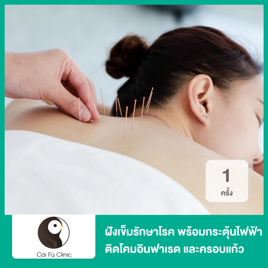ฝังเข็มรักษาโรค พร้อมกระตุ้นไฟฟ้า ติดโคมอินฟาเรด และครอบแก้ว 1 ครั้ง