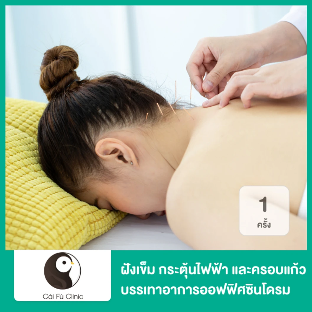 ฝังเข็ม กระตุ้นไฟฟ้า และครอบแก้ว บรรเทาอาการออฟฟิศซินโดรม ปวดตึง 1 ครั้ง