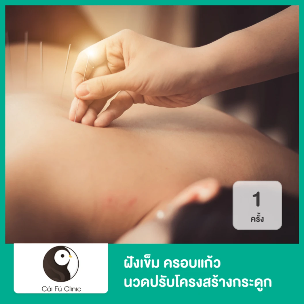 ฝังเข็ม ครอบแก้ว นวดปรับโครงสร้างกระดูก 1 ครั้ง