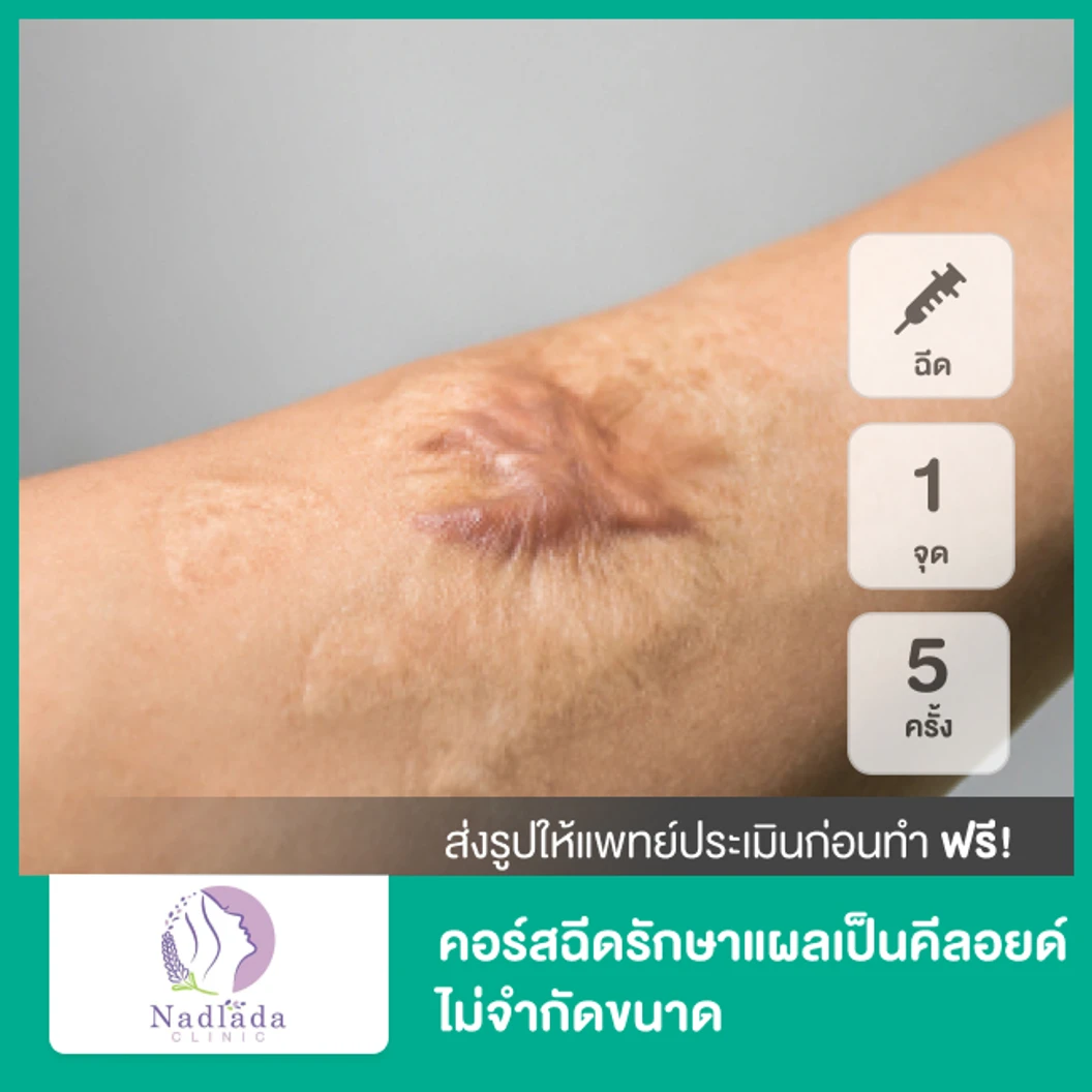 คอร์สฉีดรักษาแผลเป็นคีลอยด์ 1 จุด ไม่จำกัดขนาด 5 ครั้ง