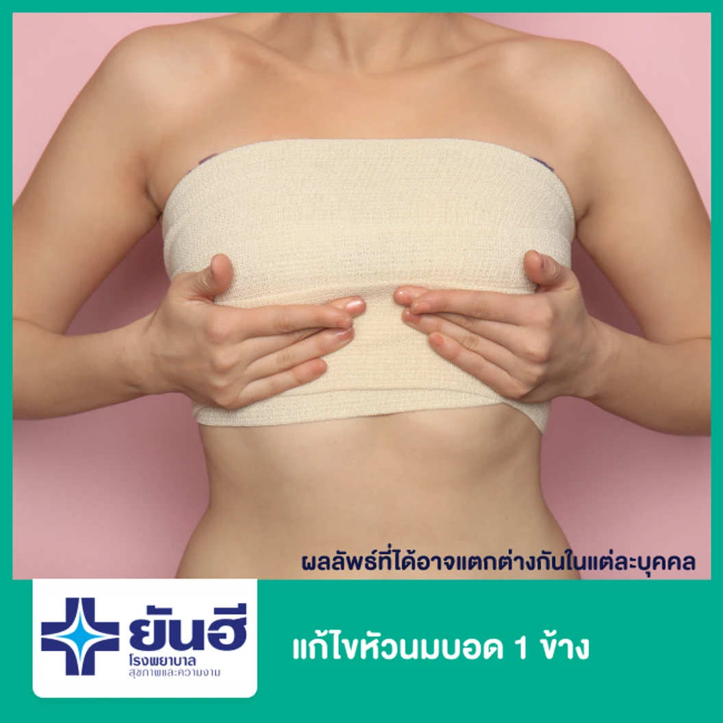 แก้ไขหัวนมบอด (Correct Inverted Nipple) 1 ข้าง