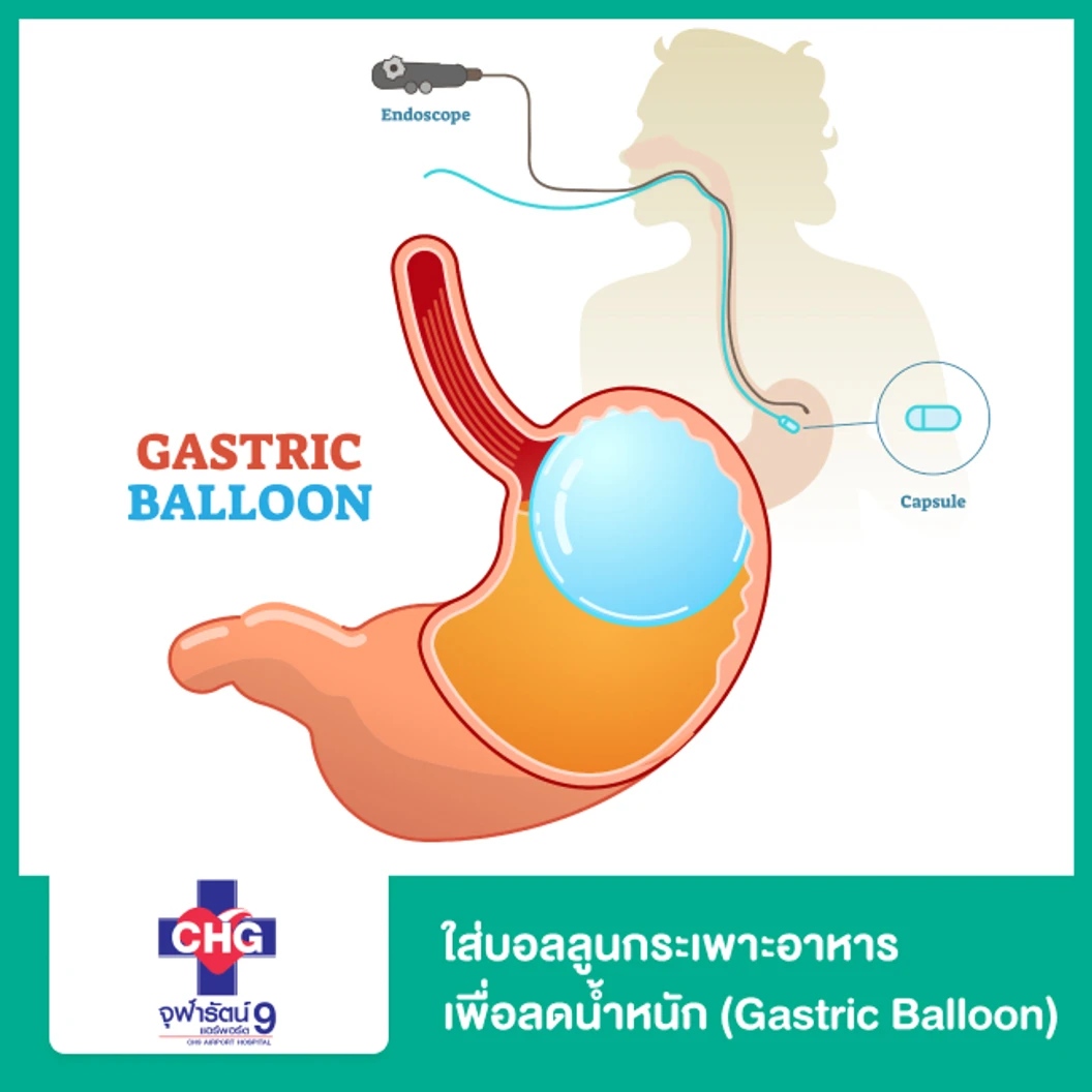 ใส่บอลลูนกระเพาะอาหารเพื่อลดน้ำหนัก (Gastric Balloon)