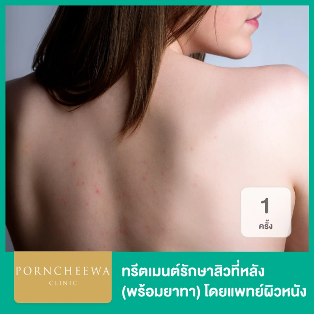ทรีตเมนต์รักษาสิวที่หลัง (พร้อมยาทา) โดยแพทย์ผิวหนัง 1 ครั้ง