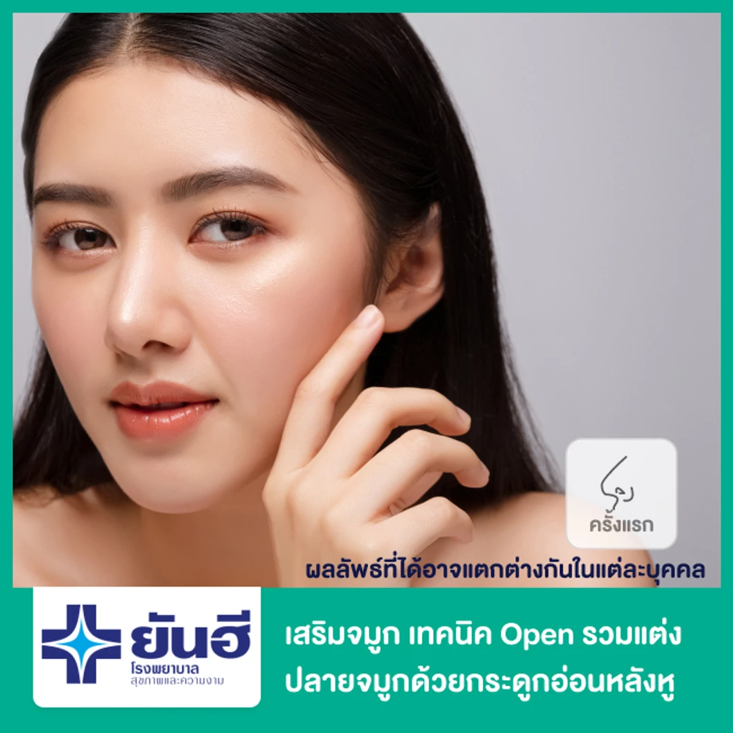 เสริมจมูก เทคนิค Open รวมแต่งปลายจมูกด้วยกระดูกอ่อนหลังหู สำหรับเคสทำครั้งแรก