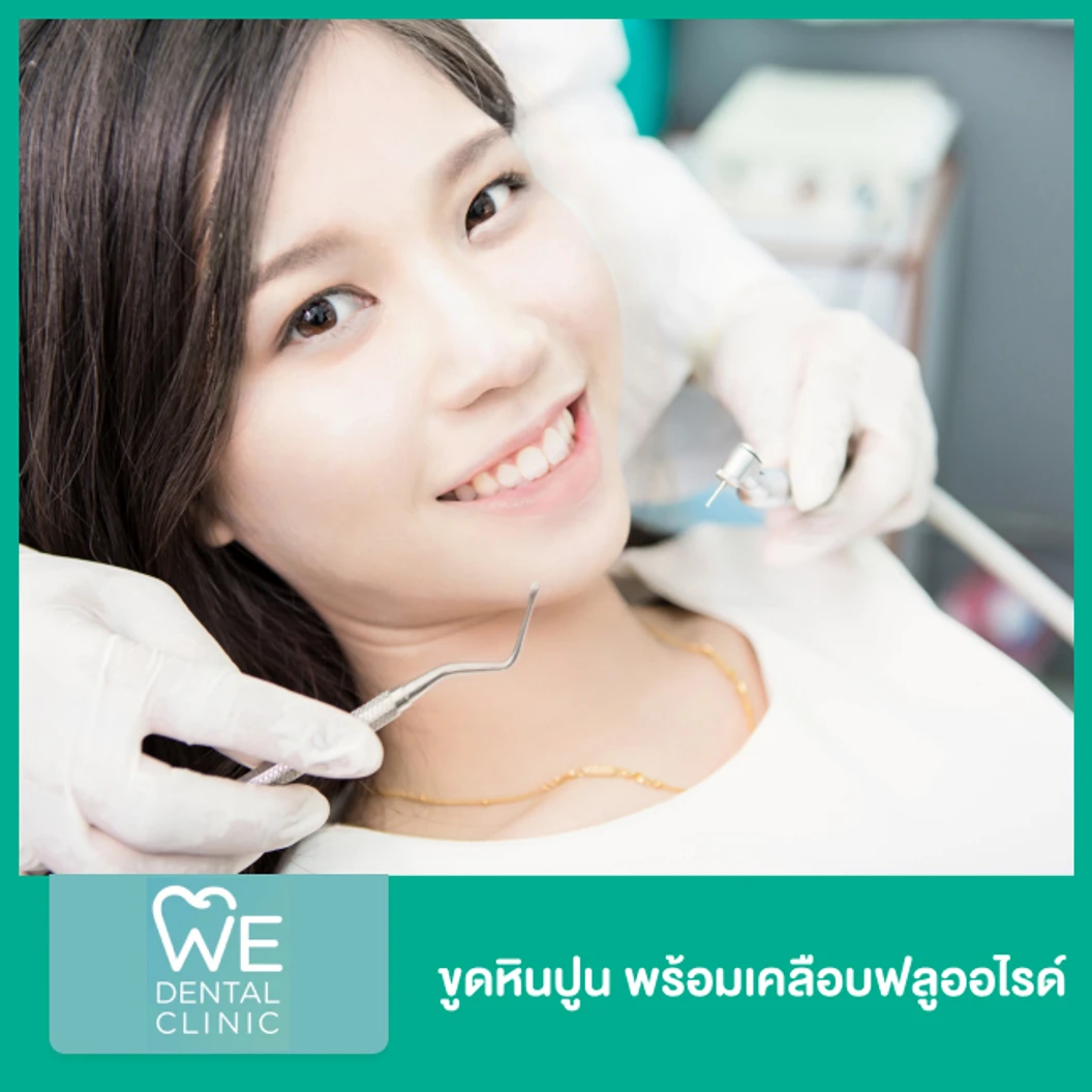 ขูดหินปูน พร้อมเคลือบฟลูออไรด์