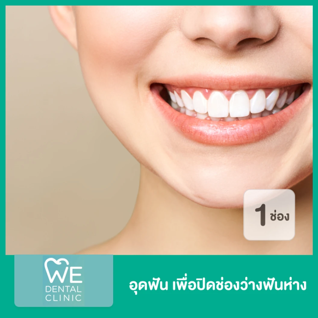 อุดฟัน เพื่อปิดช่องว่างฟันห่าง 1 ช่อง