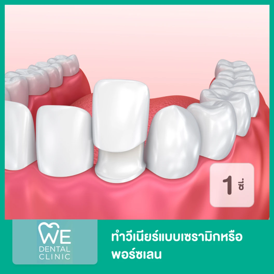 ทำวีเนียร์แบบเซรามิกหรือพอร์ซเลน 1 ซี่