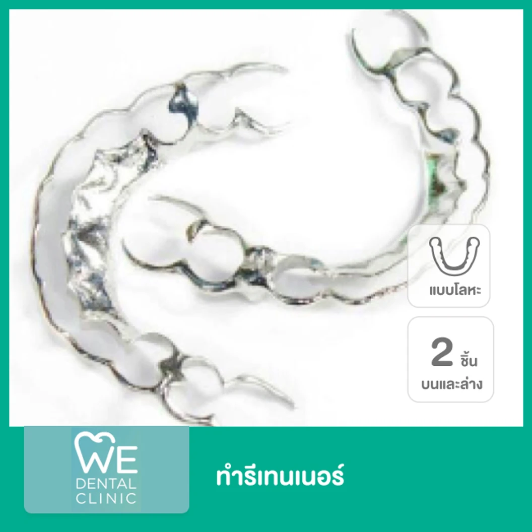 ทำรีเทนเนอร์ แบบโลหะ 2 ชิ้น ฟันบนและล่าง