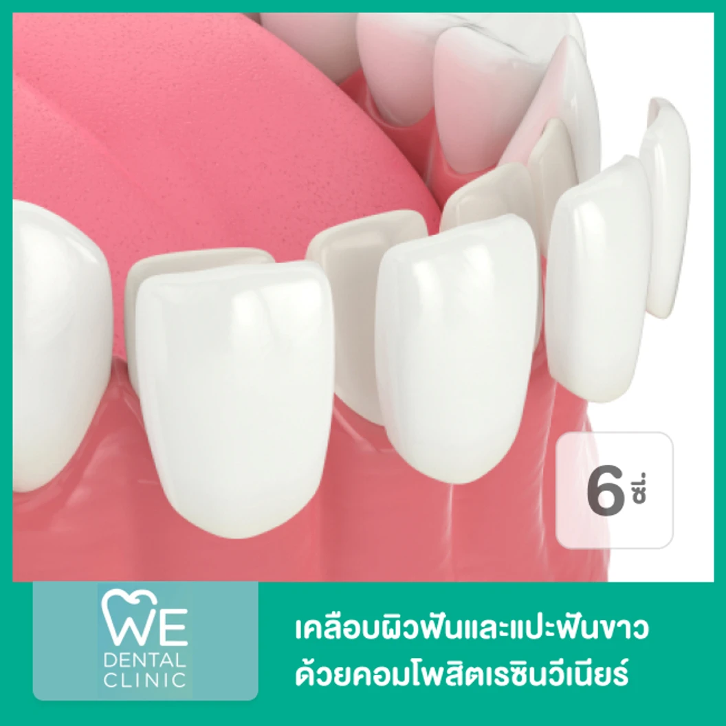 เคลือบผิวฟันและแปะฟันขาว ด้วยคอมโพสิตเรซินวีเนียร์ 6 ซี่