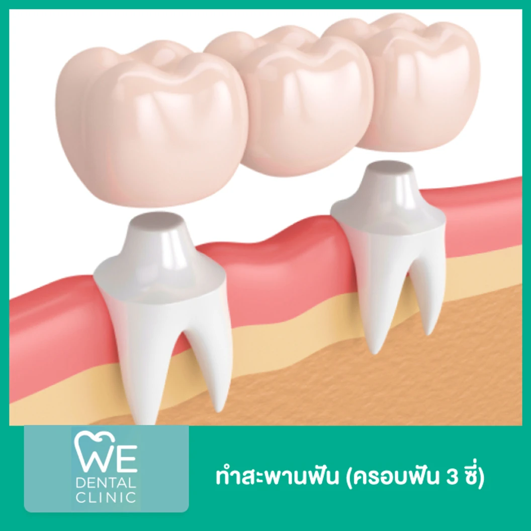 ทำสะพานฟัน (ครอบฟัน 3 ซี่)