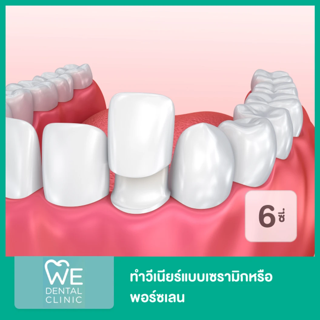 ทำวีเนียร์แบบเซรามิกหรือพอร์ซเลน 6 ซี่