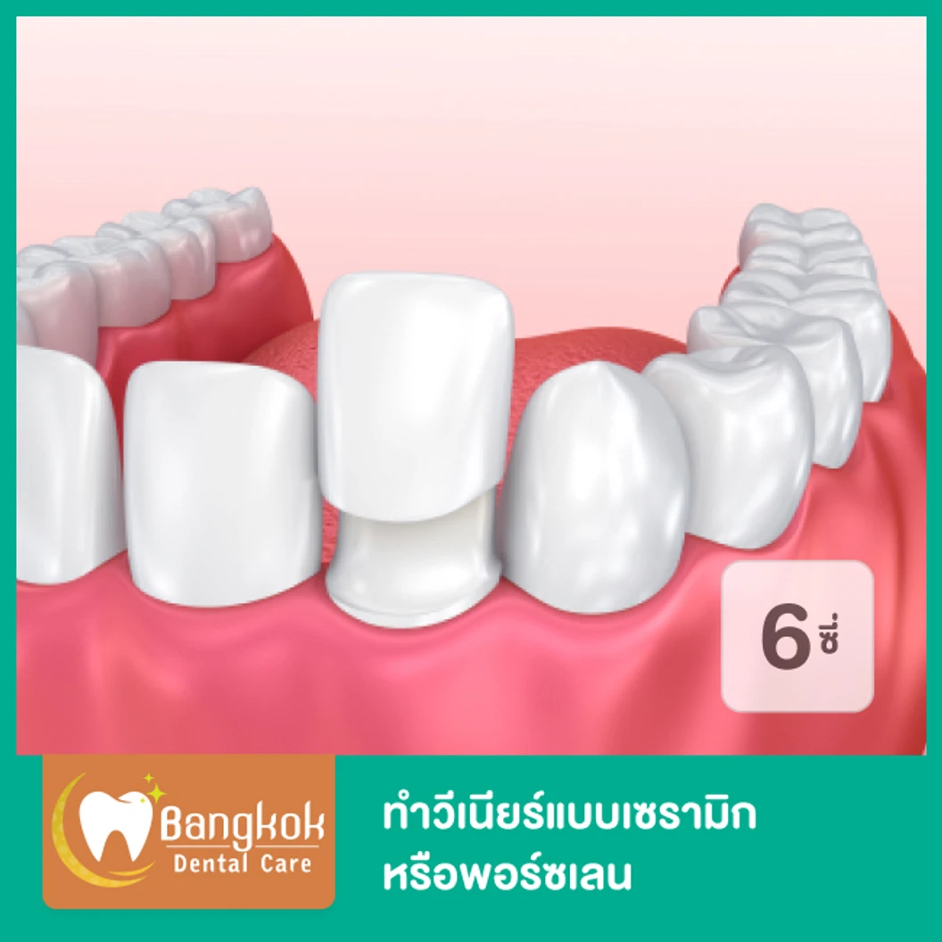 ทำวีเนียร์แบบเซรามิกหรือพอร์ซเลน 6 ซี่ ขึ้นไป