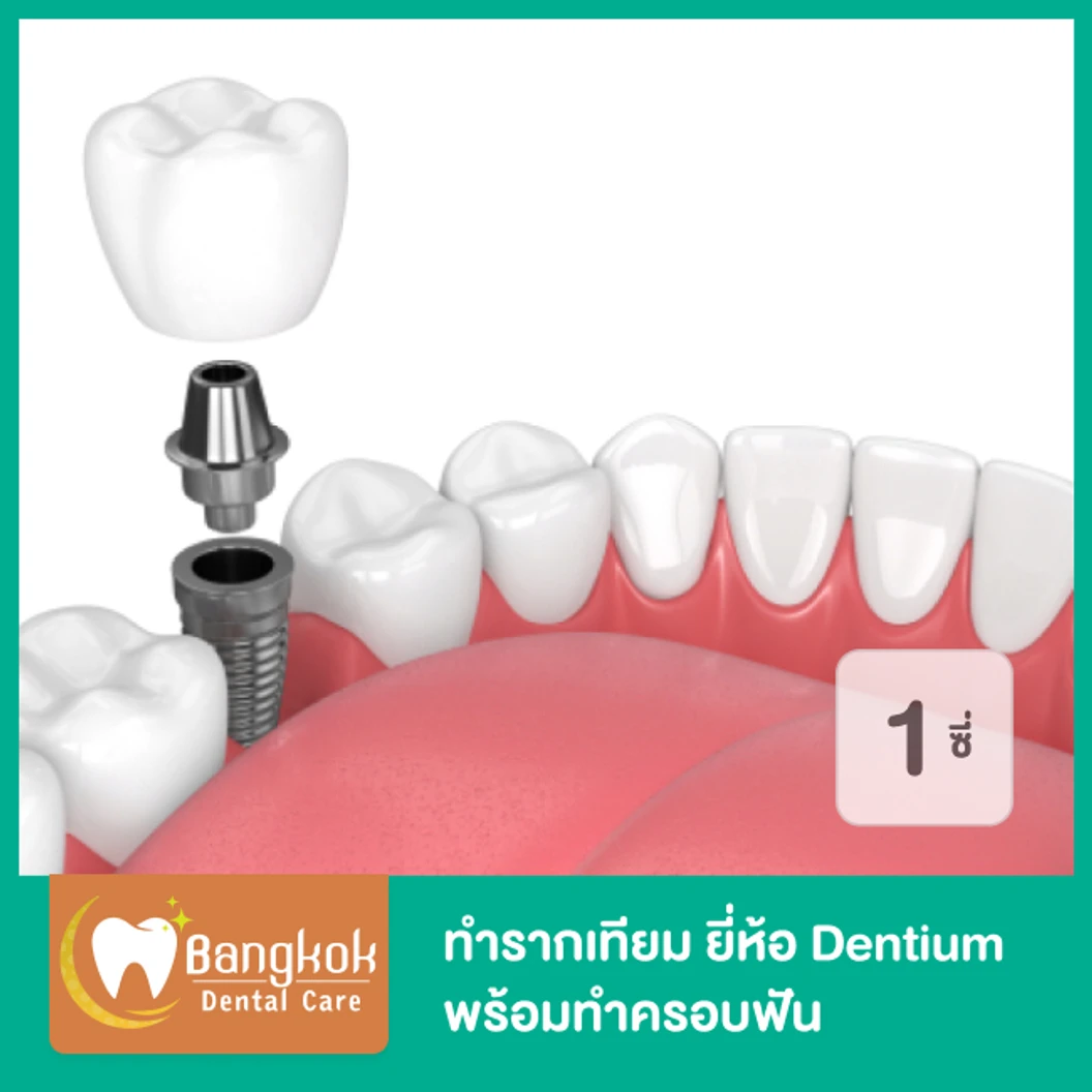 ทำรากฟันเทียม ยี่ห้อ Dentium พร้อมทำครอบฟัน สำหรับฟัน 1 ซี่