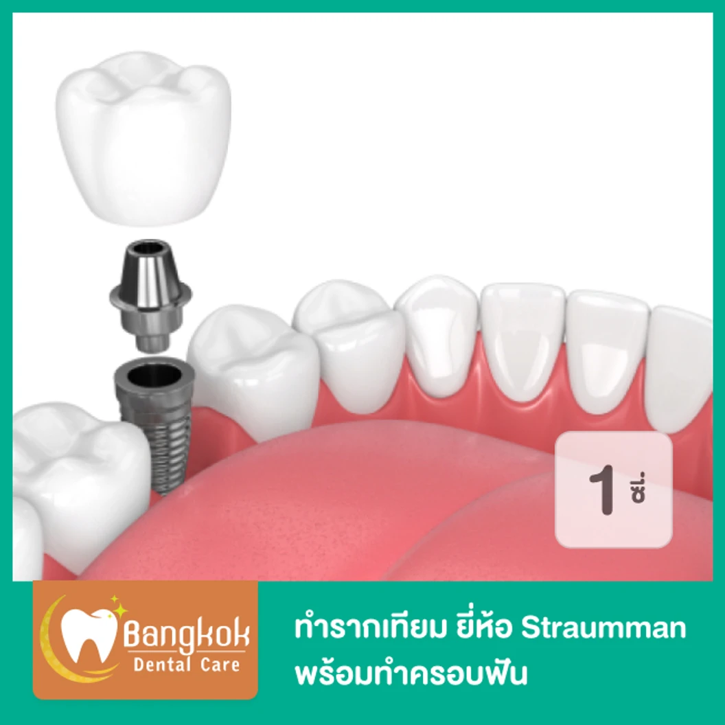ทำรากฟันเทียม ยี่ห้อ Straumman พร้อมทำครอบฟัน สำหรับฟัน 1 ซี่