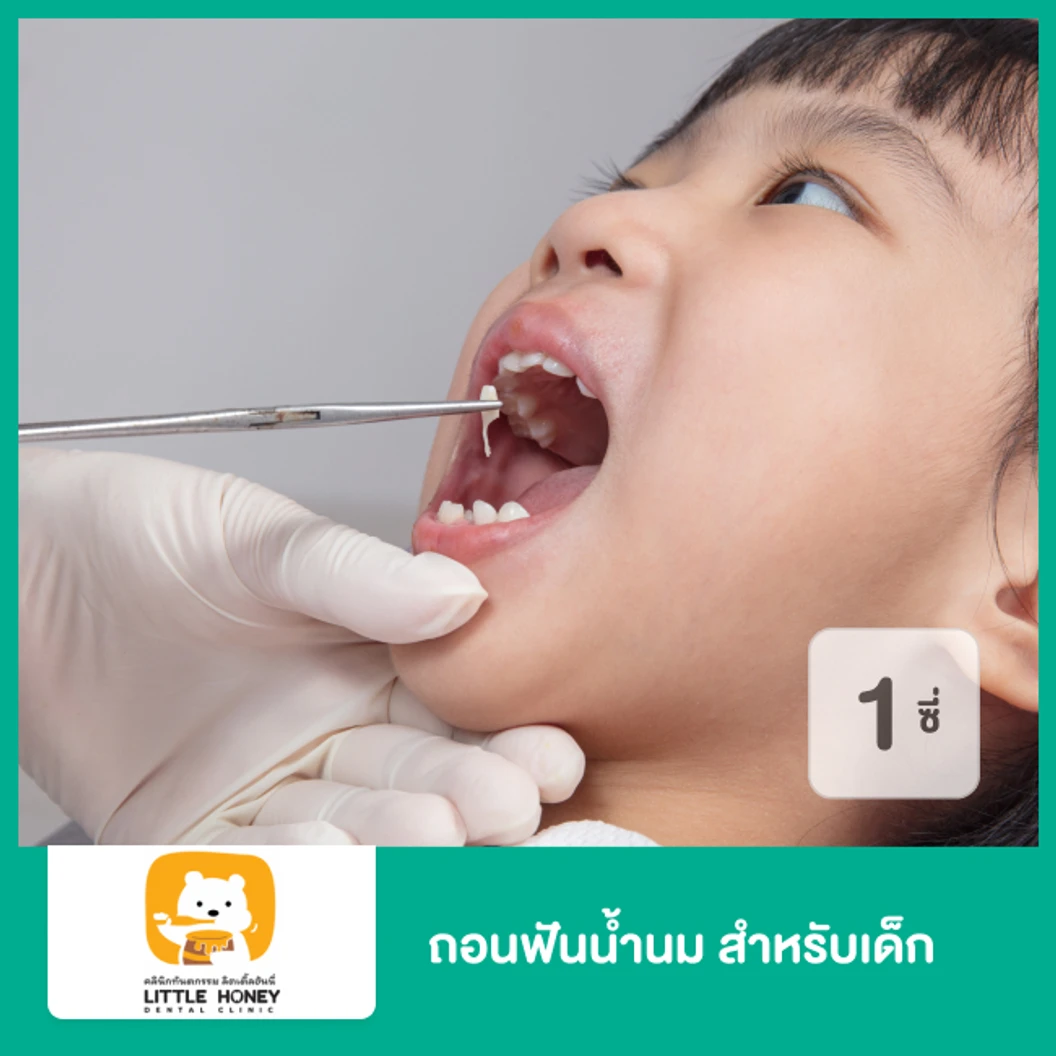 ถอนฟันน้ำนม 1 ซี่ สำหรับเด็ก