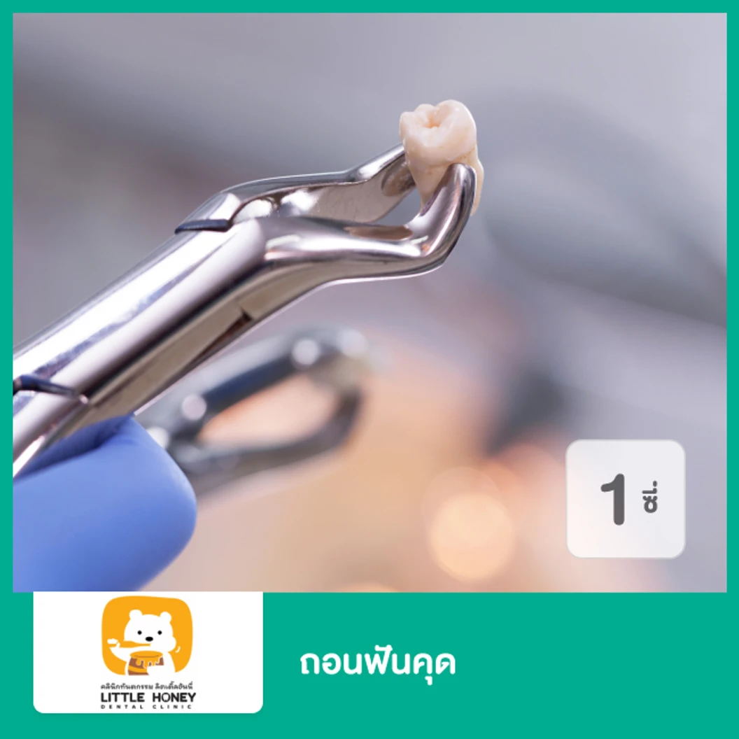 ถอนฟันคุด 1 ซี่