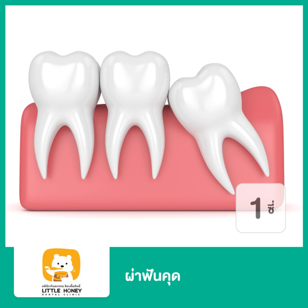 ผ่าฟันคุด 1 ซี่