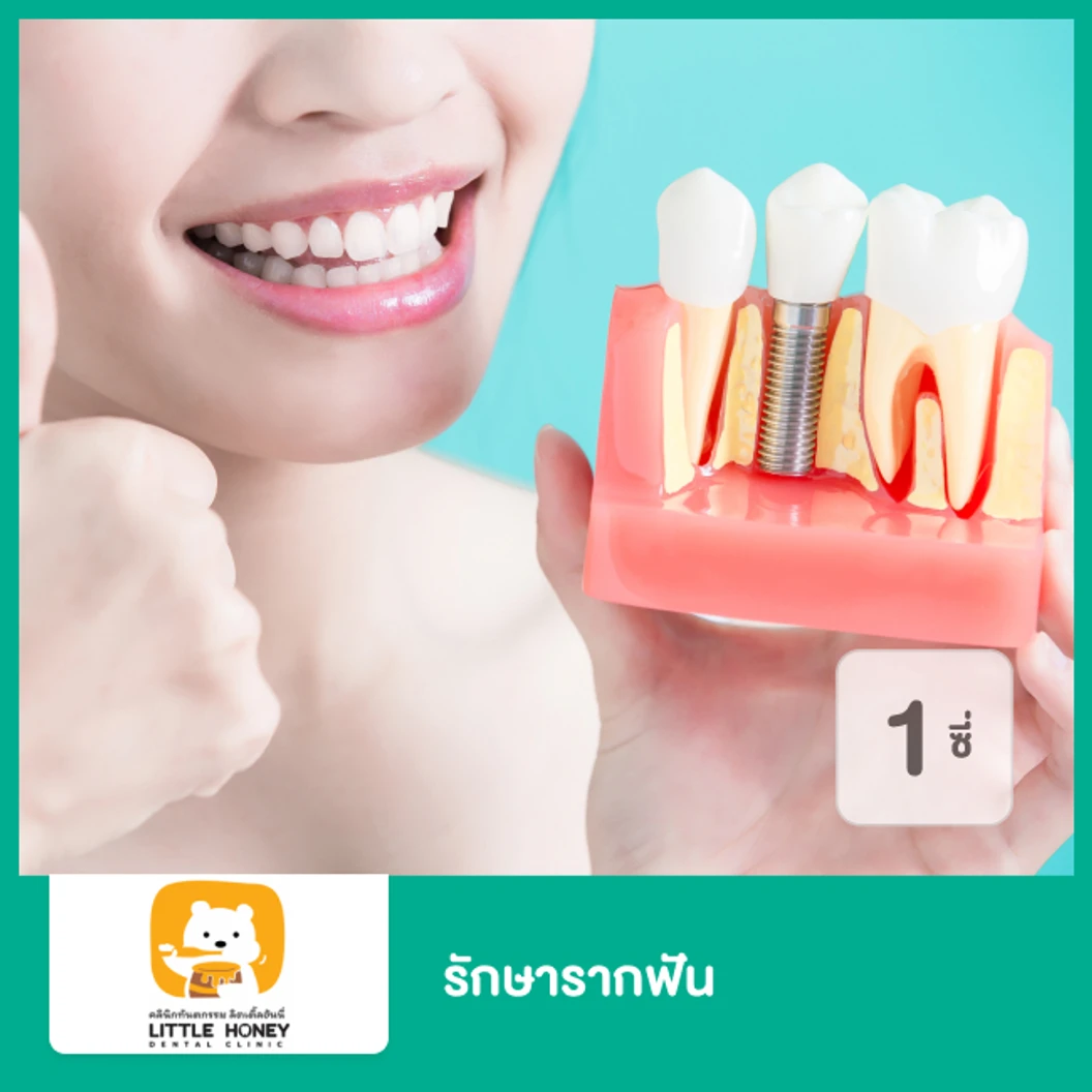 รักษารากฟัน 1 ซี่