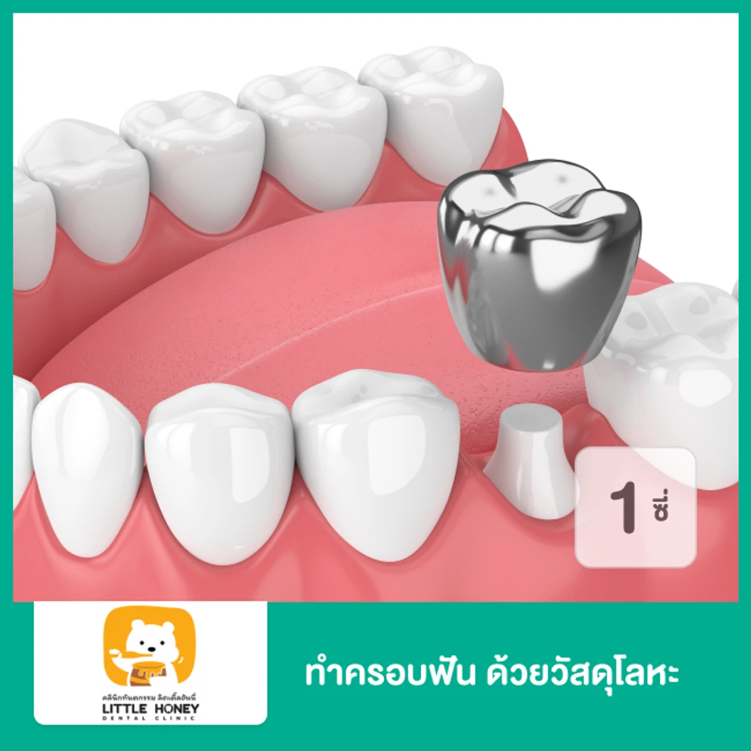 ทำครอบฟัน ด้วยวัสดุโลหะ หรือ โลหะเคลือบพอร์ซเลน สีเหมือนฟัน สำหรับฟัน 1 ซี่