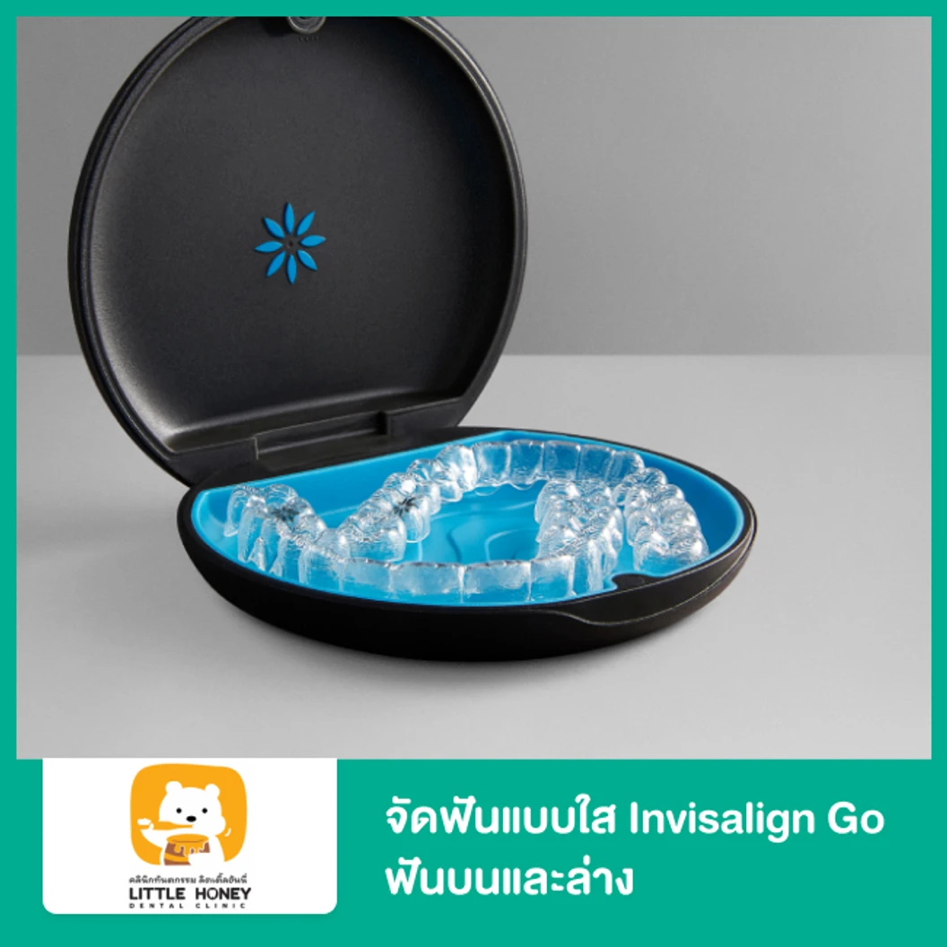 จัดฟันแบบใส Invisalign Go ฟันบนและล่าง