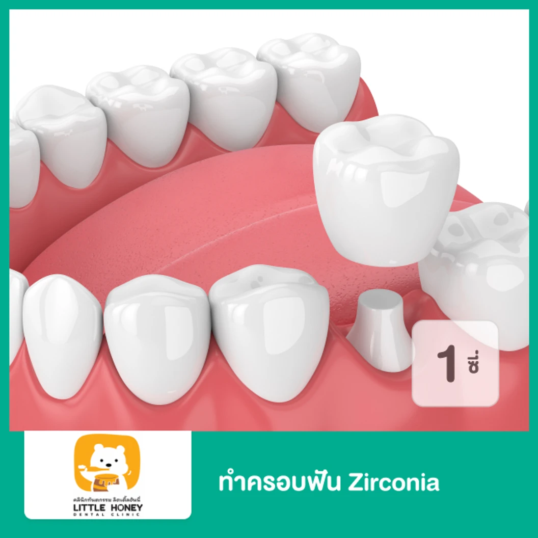 ทำครอบฟัน Zirconia สำหรับฟัน 1 ซี่