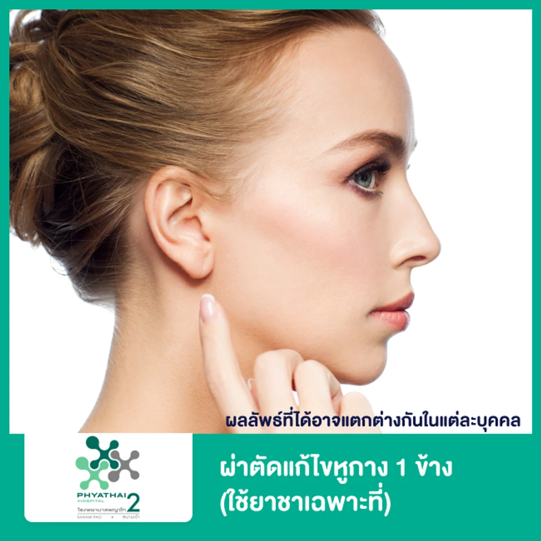 ผ่าตัดแก้ไขหูกาง 1 ข้าง (ใช้ยาชาเฉพาะที่)