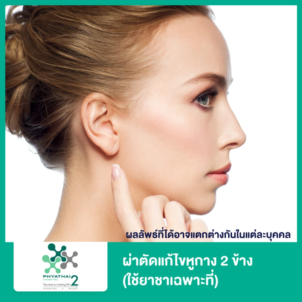 ผ่าตัดแก้ไขหูกาง 2 ข้าง (ใช้ยาชาเฉพาะที่)