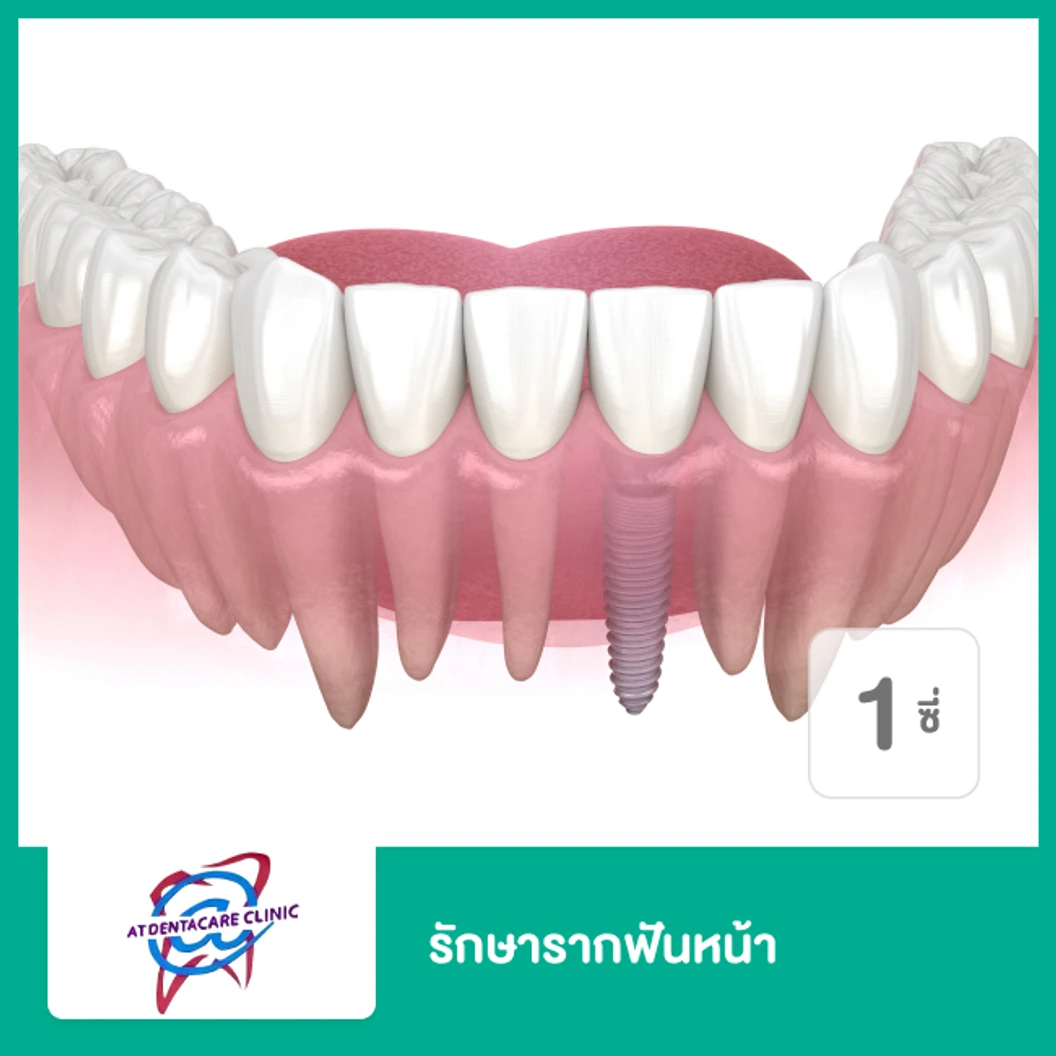 รักษารากฟันหน้า 1 ซี่