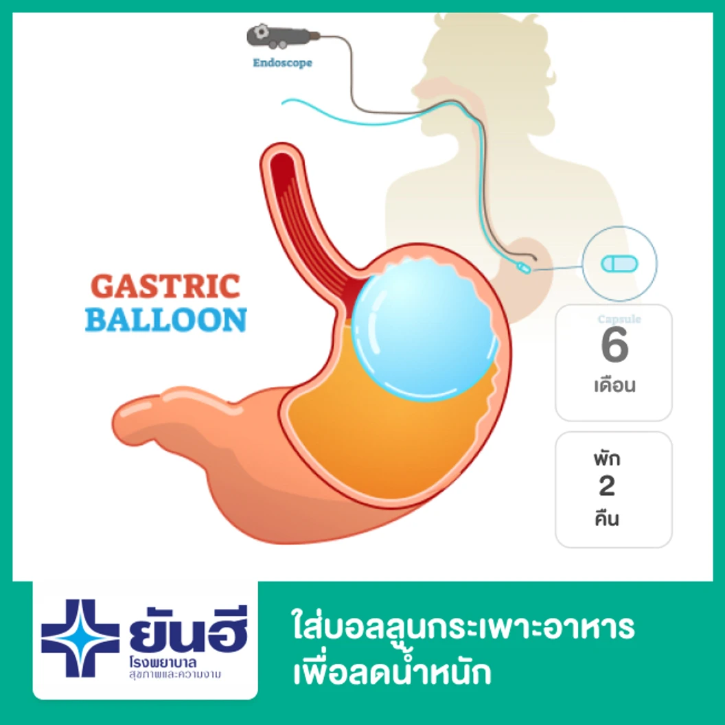 ใส่บอลลูนกระเพาะอาหารเพื่อลดน้ำหนัก (Gastric Balloon) ชนิด 6 เดือน พัก รพ. 2 คืน