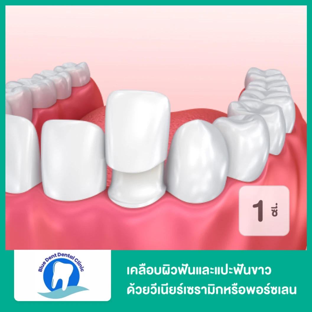 เคลือบผิวฟันและแปะฟันขาว ด้วยวีเนียร์เซรามิกหรือพอร์ซเลน E.Max 1 ซี่ (ระยะเวลารับบริการ?)