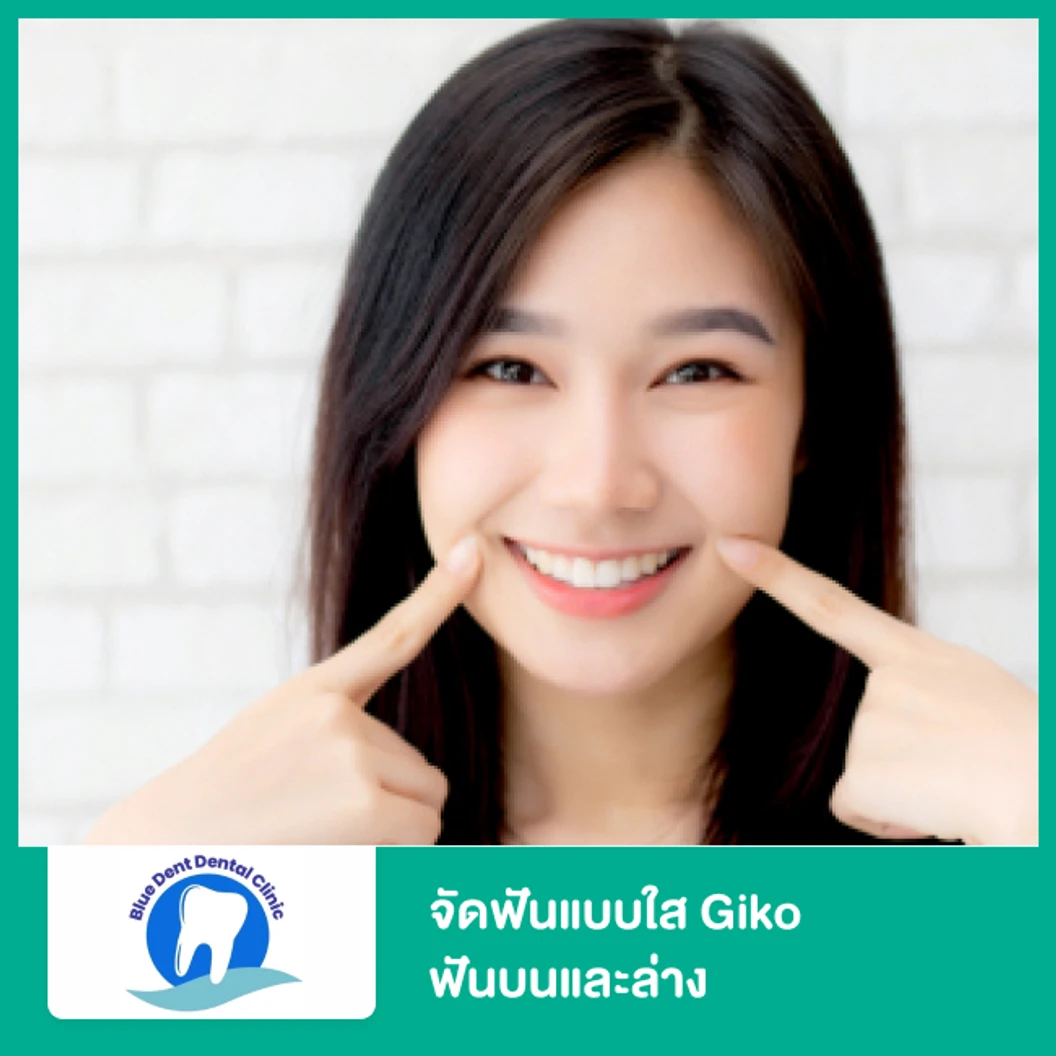 จัดฟันแบบใส Giko ฟันบนและล่าง
