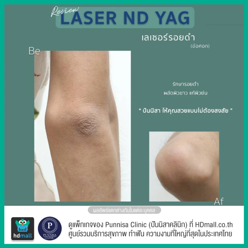 คอร์สลบรอยดำเฉพาะจุด ด้วยเลเซอร์ ND-YAG 1 จุด 12 ครั้ง ภายใน 1 ปี