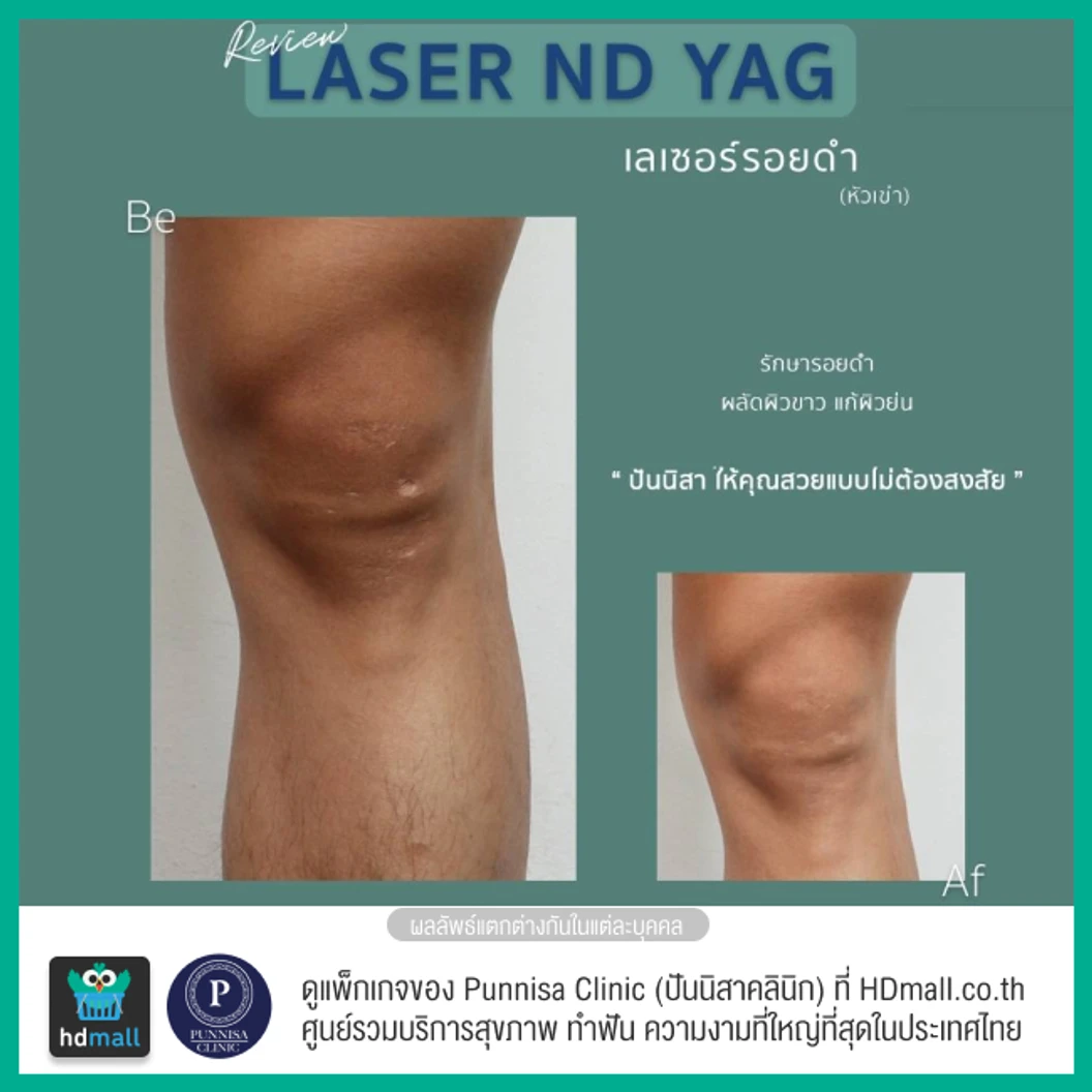 คอร์สลบรอยดำเฉพาะจุด ด้วยเลเซอร์ ND-YAG 1 จุด 12 ครั้ง ภายใน 1 ปี