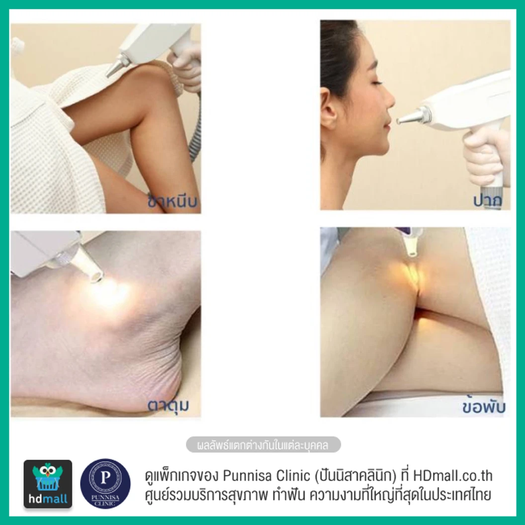 คอร์สลบรอยดำเฉพาะจุด ด้วยเลเซอร์ ND-YAG 1 จุด 12 ครั้ง ภายใน 1 ปี