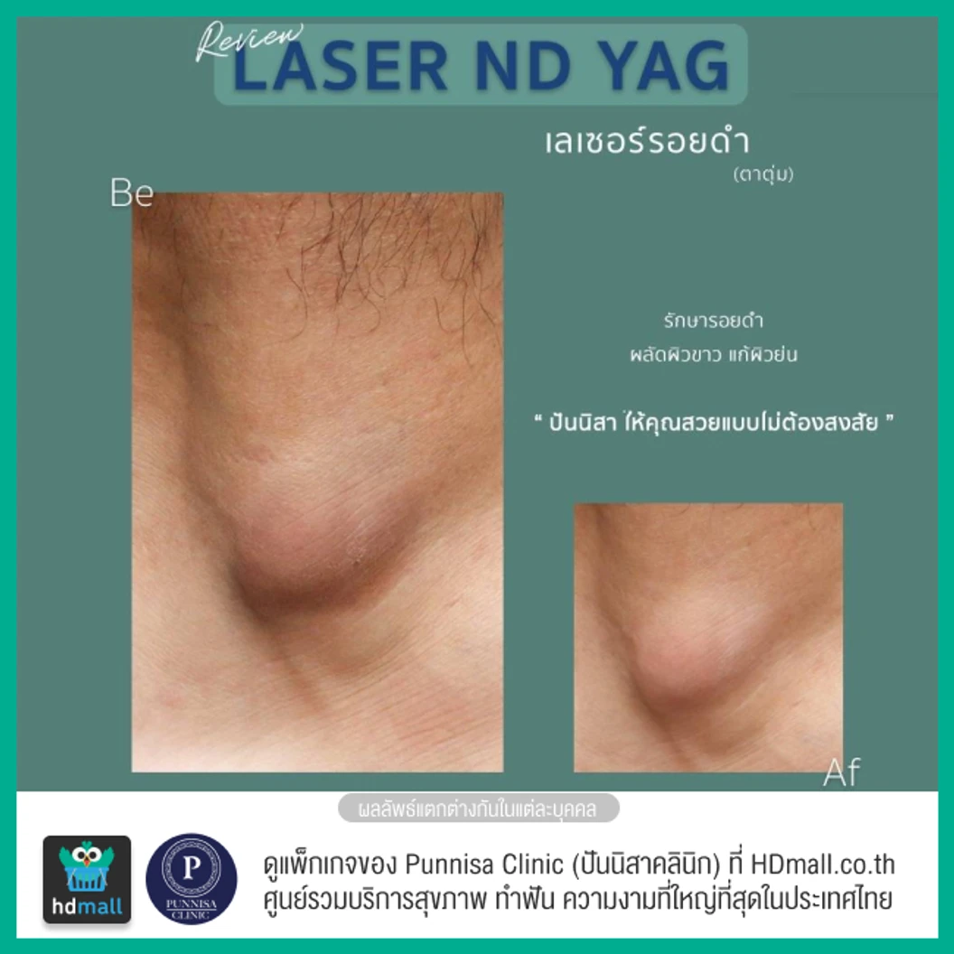 ลบรอยดำเฉพาะจุด ด้วยเลเซอร์ ND-YAG 1 จุด 1 ครั้ง