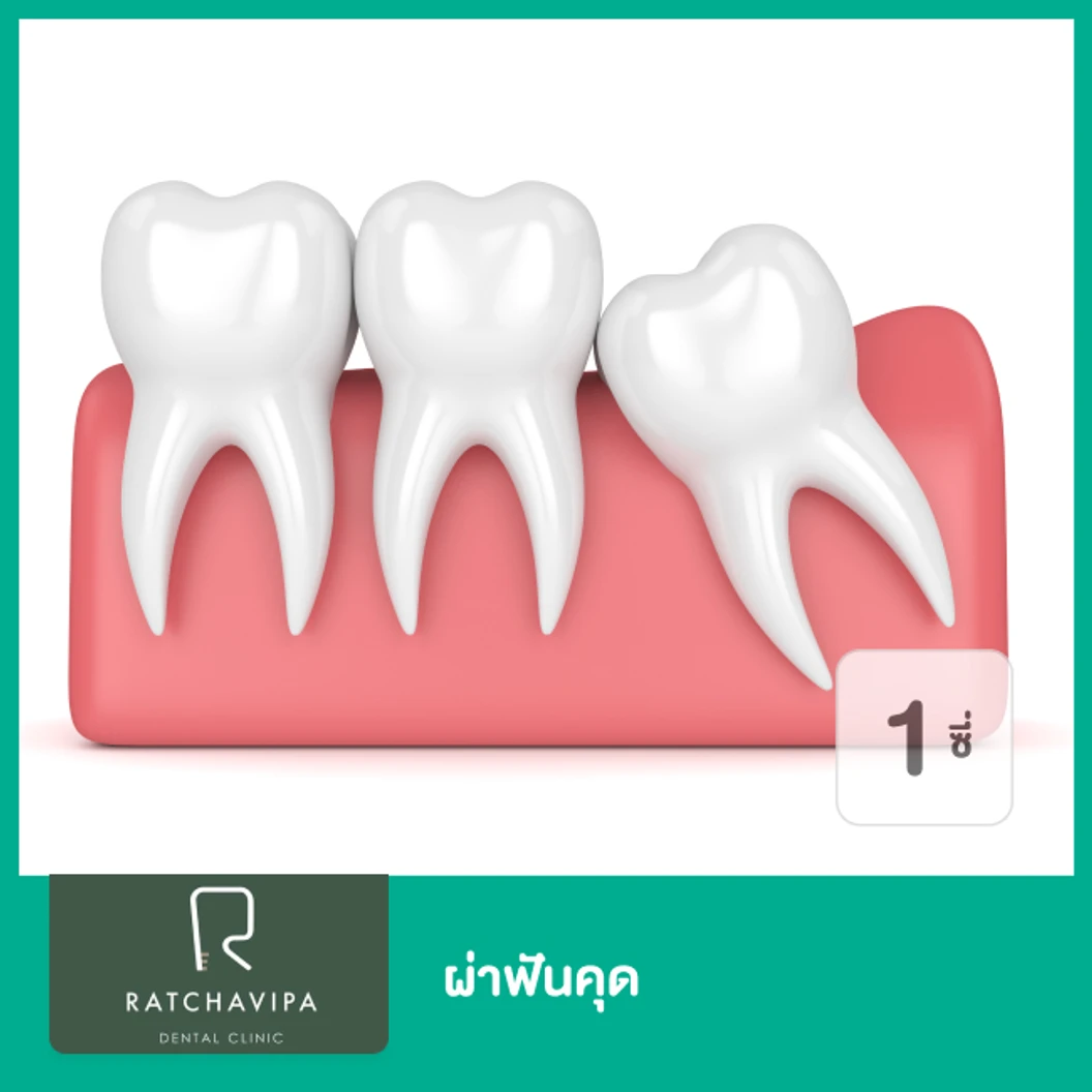 ผ่าฟันคุด 1 ซี่