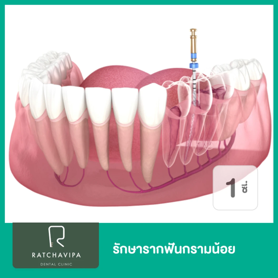 รักษารากฟันกรามน้อย 1 ซี่