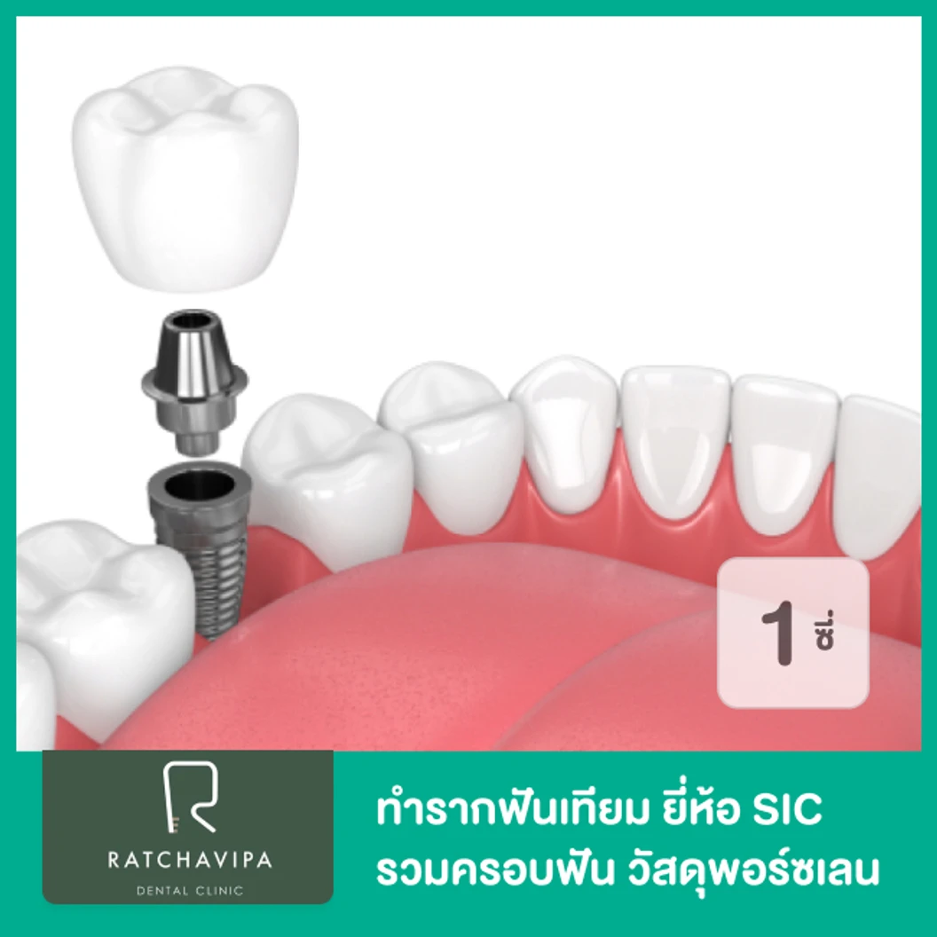 ทำรากฟันเทียม ยี่ห้อ SIC รวมครอบฟัน วัสดุพอร์ซเลน สำหรับฟัน 1 ซี่