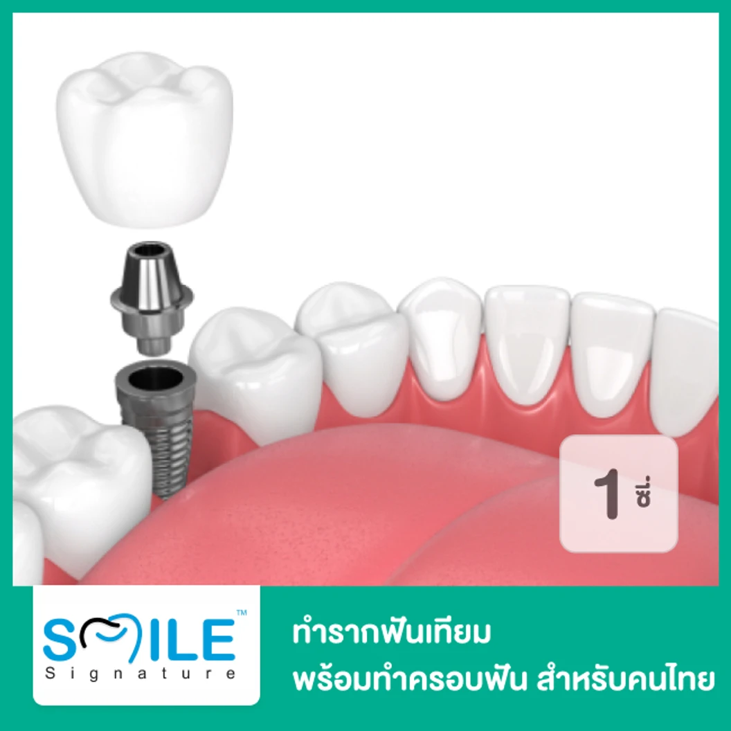 ทำรากฟันเทียม ยี่ห้อ P-I พร้อมทำครอบฟัน สำหรับฟัน 1 ซี่ สำหรับคนไทย