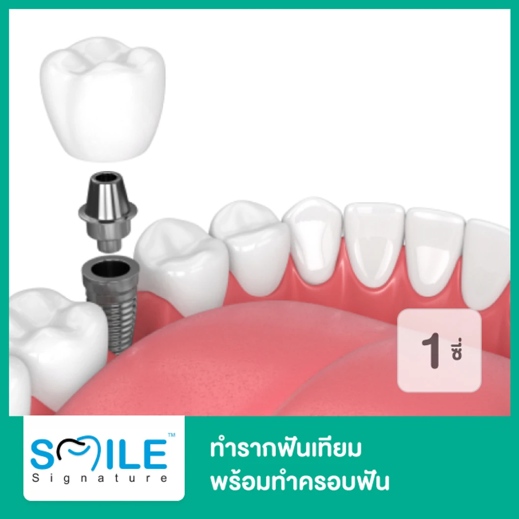 ทำรากฟันเทียม ยี่ห้อ Straumann SLA พร้อมทำครอบฟัน สำหรับฟัน 1 ซี่