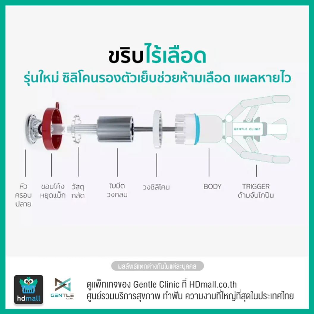ขริบไร้เลือด ขริบปลายอวัยวะเพศชายด้วยเครื่องมือไทเทเนียม พร้อมตรวจระดับฮอร์โมน 4 รายการ